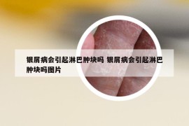 银屑病会引起淋巴肿块吗 银屑病会引起淋巴肿块吗图片