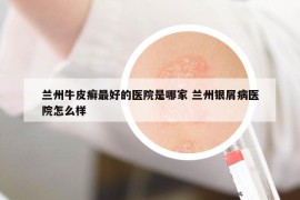 兰州牛皮癣最好的医院是哪家 兰州银屑病医院怎么样