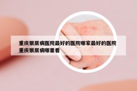 重庆银屑病医院最好的医院哪家最好的医院 重庆银屑病哪里看