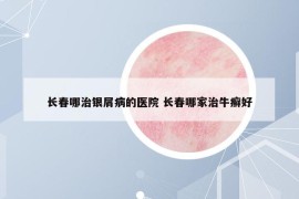 长春哪治银屑病的医院 长春哪家治牛癣好