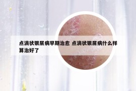 点滴状银屑病早期治愈 点滴状银屑病什么样算治好了