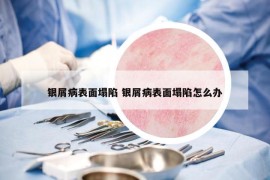 银屑病表面塌陷 银屑病表面塌陷怎么办