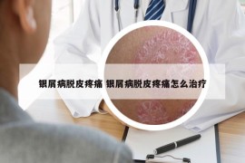 银屑病脱皮疼痛 银屑病脱皮疼痛怎么治疗