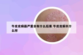 牛皮皮癣最严重会有什么后果 牛皮皮癣长什么样