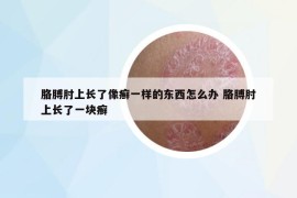 胳膊肘上长了像癣一样的东西怎么办 胳膊肘上长了一块癣