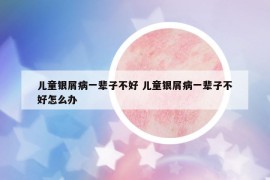 儿童银屑病一辈子不好 儿童银屑病一辈子不好怎么办