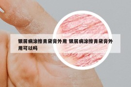 银屑病涂擦青黛膏外用 银屑病涂擦青黛膏外用可以吗