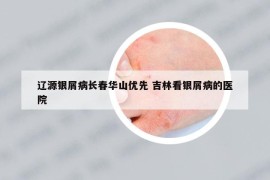 辽源银屑病长春华山优先 吉林看银屑病的医院