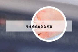 牛皮癣眼红怎么回事