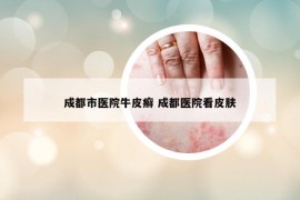 成都市医院牛皮癣 成都医院看皮肤