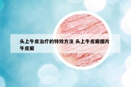 头上牛皮治疗的特效方法 头上牛皮廨图片 牛皮廨