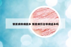 银屑病带病回乡 银屑病符合带病返乡吗