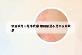 银屑病是不是牛皮廨 银屑病是不是牛皮廨发病