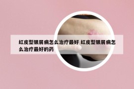 红皮型银屑病怎么治疗最好 红皮型银屑病怎么治疗最好的药