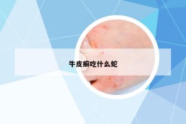 牛皮癣吃什么蛇