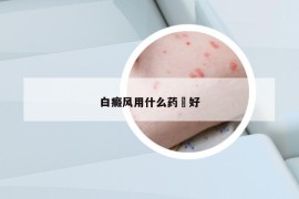 白癜风用什么药抺好