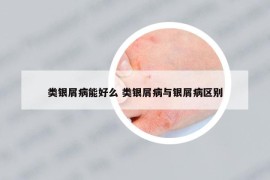 类银屑病能好么 类银屑病与银屑病区别