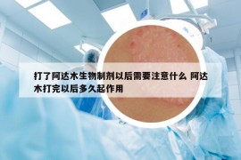 打了阿达木生物制剂以后需要注意什么 阿达木打完以后多久起作用