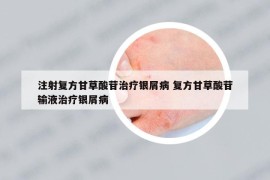 注射复方甘草酸苷治疗银屑病 复方甘草酸苷输液治疗银屑病