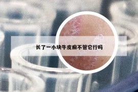 长了一小块牛皮癣不管它行吗