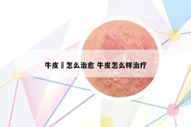 牛皮廯怎么治愈 牛皮怎么样治疗