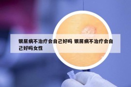 银屑病不治疗会自己好吗 银屑病不治疗会自己好吗女性