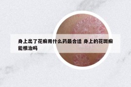 身上出了花癣用什么药最合适 身上的花斑癣能根治吗