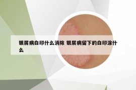 银屑病白印什么消除 银屑病留下的白印涂什么