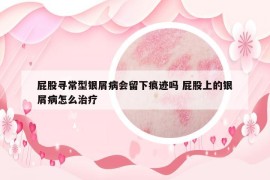 屁股寻常型银屑病会留下痕迹吗 屁股上的银屑病怎么治疗