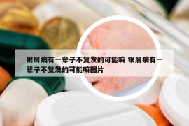 银屑病有一辈子不复发的可能嘛 银屑病有一辈子不复发的可能嘛图片