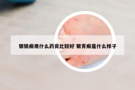 银销癣用什么药膏比较好 银宵癣是什么样子