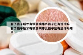 有了孩子后才有银屑病那么孩子还有遗传吗 有了孩子后才有银屑病那么孩子还有遗传吗知乎