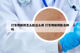 打生物制剂怎么脸这么痒 打生物制剂脸会肿吗