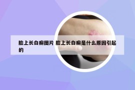 脸上长白癣图片 脸上长白癣是什么原因引起的