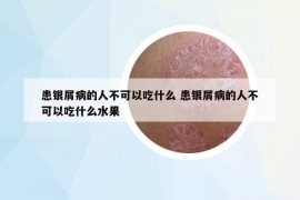 患银屑病的人不可以吃什么 患银屑病的人不可以吃什么水果