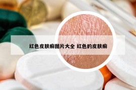 红色皮肤癣图片大全 红色的皮肤癣