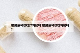 银屑病可以吃炸鸡腿吗 银屑病可以吃鸡腿吗?