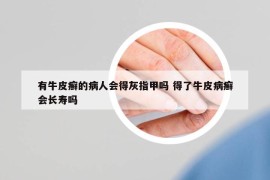 有牛皮癣的病人会得灰指甲吗 得了牛皮病癣会长寿吗