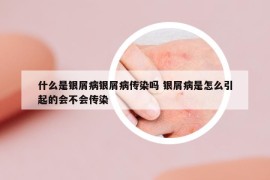 什么是银屑病银屑病传染吗 银屑病是怎么引起的会不会传染