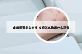 皮癣需要怎么治疗 皮癣怎么治用什么药膏