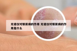 光谱仪对银屑病的作用 光谱仪对银屑病的作用是什么