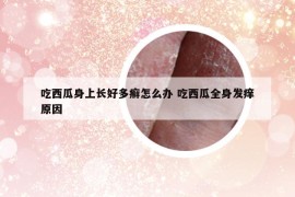 吃西瓜身上长好多癣怎么办 吃西瓜全身发痒原因