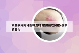 银屑病用阿可匹林洗吗 银屑病吃阿维a皮损的变化