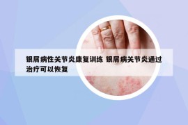 银屑病性关节炎康复训练 银屑病关节炎通过治疗可以恢复