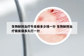 生物制剂治疗牛皮癣多少钱一针 生物制剂治疗银屑病多久打一针