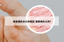 银屑病共分几种类型 银屑病分几种?