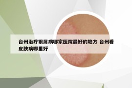 台州治疗银屑病哪家医院最好的地方 台州看皮肤病哪里好