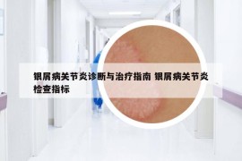 银屑病关节炎诊断与治疗指南 银屑病关节炎检查指标