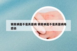 银屑病是不是真菌病 银屑病是不是真菌病毒感染