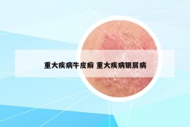 重大疾病牛皮癣 重大疾病银屑病